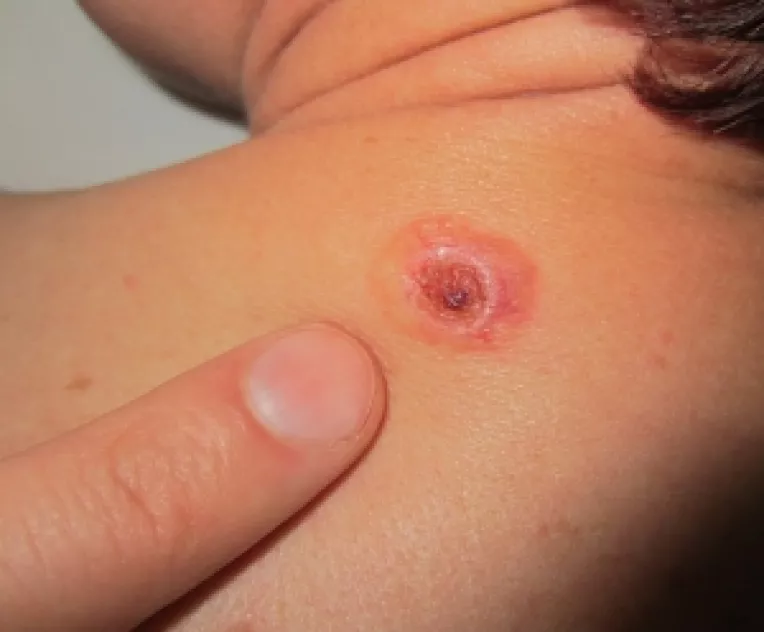 Campanie dedicata exclusiv consultatiilor gratuite, pentru elevi, de EuroMelanoma Day